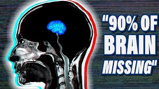 The Most Bizarre Medical Case in Neuroscience [upl. by Oneil621]