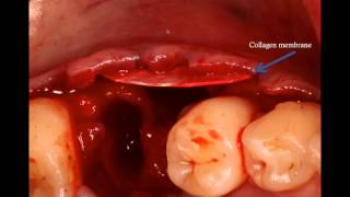 How to handle the missing buccal plate Surgical Master Instant Replay [upl. by Llenal653]