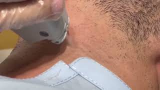 permanent Hair removal treatment hairremoval dermatology dermalab skincare gentlelase [upl. by Arreip]