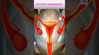 Ectopic pregnancypregnancy pregnancyjourney [upl. by Adiarf848]