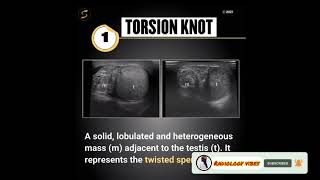 Scrotal Cancer UltrasoundTesticular UltrasoundUltrasound course [upl. by Maiga261]