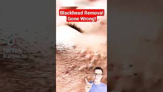 TERRIBLE BLACKHEAD REMOVAL  Shocked At This One shorts [upl. by Shalna]