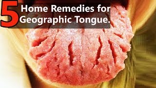 Top 5 Home Remedies for Treating Geographic Tongue  By Top 5 [upl. by Anerdna]