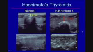 Sonographic Evaluation of Diffuse Thyroid Disease [upl. by Ambrosine]