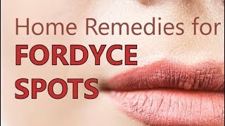 Home Remedies for Fordyce Spots  Treatment Methods Natural Cure [upl. by Harrow]