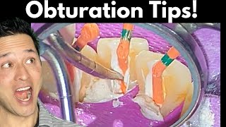 Root Canal Obturation Simplified  Tips to Save You Time [upl. by Elocim467]