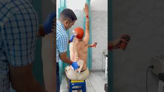 Severe idiopathic scoliosis treatment by DrRavi scoliosis chiropractor trend spine chiropractic [upl. by Maxwell]