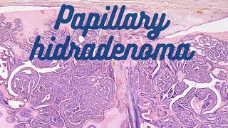 Papillary Hidradenoma [upl. by Anyel]