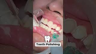 Step By Step Teeth Polishing  Smile Designing  Happy Smiles dental Care  shorts [upl. by Adaurd]