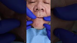 🦷 Implantes en maxilar superior e inferior para una sonrisa renovada ✨ implantesdentales shorts [upl. by Mcnutt212]