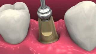 Restoring BioHorizons Dental Implants 2011 [upl. by Dagall]