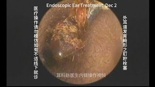 Embolization of earwax in the development of abnormal external auditory canal 20241202 [upl. by Scammon486]