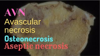 Avascular Necrosis  Pathology mini tutorial [upl. by Rew]