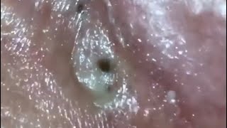 Popping Big Blackheads 😱 [upl. by Sheepshanks]