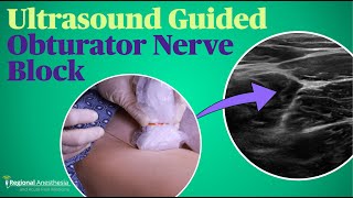 Ultrasound Guided Obturator Nerve Block [upl. by Hallsy]