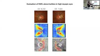 Primary Open Angle Glaucoma Dr Christopher Leung [upl. by Derman]