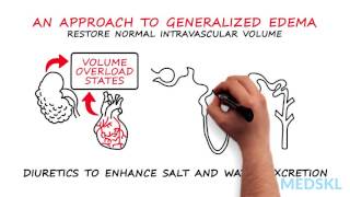 Nephrology – Generalized Edema By Timothy Yau MD and Michael Connor MD [upl. by Annaert]