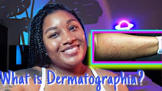 What is Dermatographia  Living with it  help ease it Dermatographism DermatographicUrticaria [upl. by Duax]