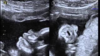 Echographie dun foetus qui tète in utero [upl. by Flossie]