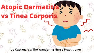 ⛑️ Atopic Dermatitis Eczema vs Tinea Corporis Ringworm jordanjowanderingpractitioner [upl. by Naesar]