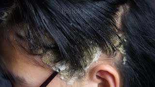 Dandruff scratching removal on head using black combing407 [upl. by Poole]