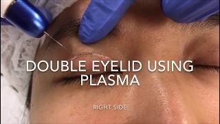 Plasma Double eyelid [upl. by Ayot]