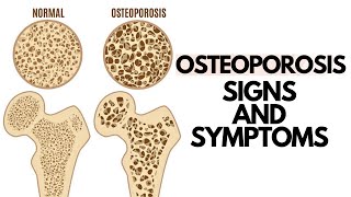 OSTEOPOROSIS Early Symptoms Causes Diet Exercise Prevention and Treatment [upl. by Klimesh]