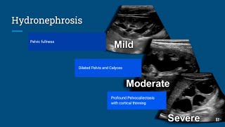 Hydronephrosis Ultrasound [upl. by Milka]