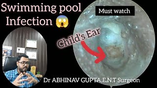 Microsuction Magic Clearing Swimmers Ear Infection in a Child [upl. by Jamila]