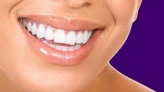 184 Teeth whitening Procedure Carbamide Peroxide [upl. by Acinorrev326]