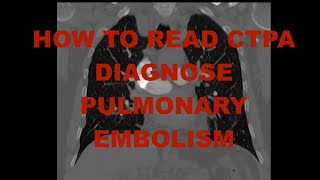 How to read a CTPA and diagnose a PE CT pulmonary angiogram  pulmonary embolism [upl. by Ahsaekal]