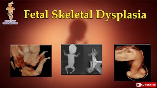 Fetal Skeletal Dysplasia [upl. by Gratt]