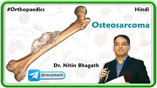 Osteosarcoma Hindi  Orthopedic Lectures [upl. by Sabina]