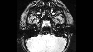 Vasospasm Secondary to Subarachnoid Hemorrhage [upl. by Repsaj203]