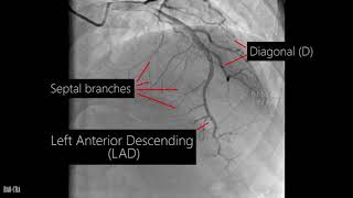 Coronary artery anatomy  Coronary angiogram [upl. by Crosby]