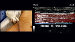 Transversus Abdominis Plane TAP Block  UltrasoundGuided Demonstration [upl. by Rotman]