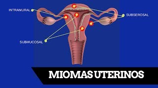 Como Eliminar Miomas Sin Histerectomía [upl. by Fu]