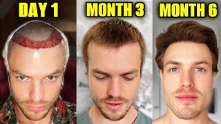 My Hair Transplant Results After 6 Months Before amp After [upl. by Cristabel]