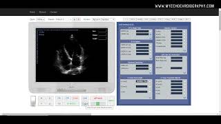 Ejection Fraction EF [upl. by Ahseiyt]