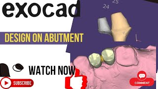 DESIGN ON CUSTOM ABUTMENT IMPLANT IN EXOCAD exocad smiledesign implants [upl. by Hess]