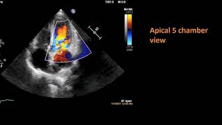 Bicuspid aortic valve with infective endocarditis II Full Echocardiography Assessment [upl. by Bahe]