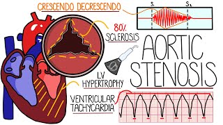 Aortic Stenosis Explained in 10 Minutes With Heart Murmur Sound [upl. by Pepita]