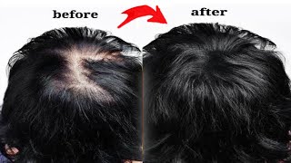 Increase Hair Volume amp turn Thin Hair to Thick Hair with Vitamin E Oil  Aloevera Hair Growth Serum [upl. by Sykleb]