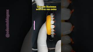 Cierre de diastemas con resina shorts resinadental odontologia diastema carillasderesina [upl. by Akcebar]