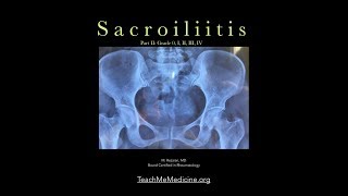 Sacroiliitis A common cause of back pain Part II [upl. by Mila]