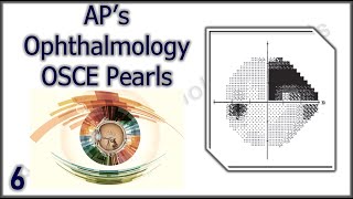 APs Ophthalmology OSCE Pearls 6 [upl. by Lipski]