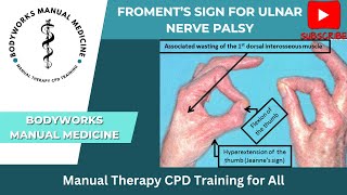 Froments Sign for Ulnar Nerve Palsy [upl. by Aecila696]