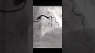 Angioplasty to LAD after thrombolysis after one day [upl. by Pet]