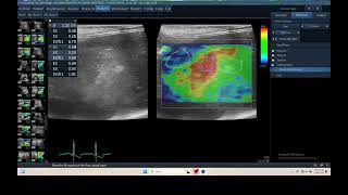 IQ 306 LIVER HEPATOMA ULTRASOUND ECHOPAC ANALYSIS ELASTOGRAPHY 2 [upl. by Noevart]