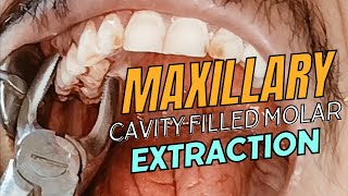 Upper cavity filled molar extraction using forcep  tooth extraction  molars extraction [upl. by Erleena656]